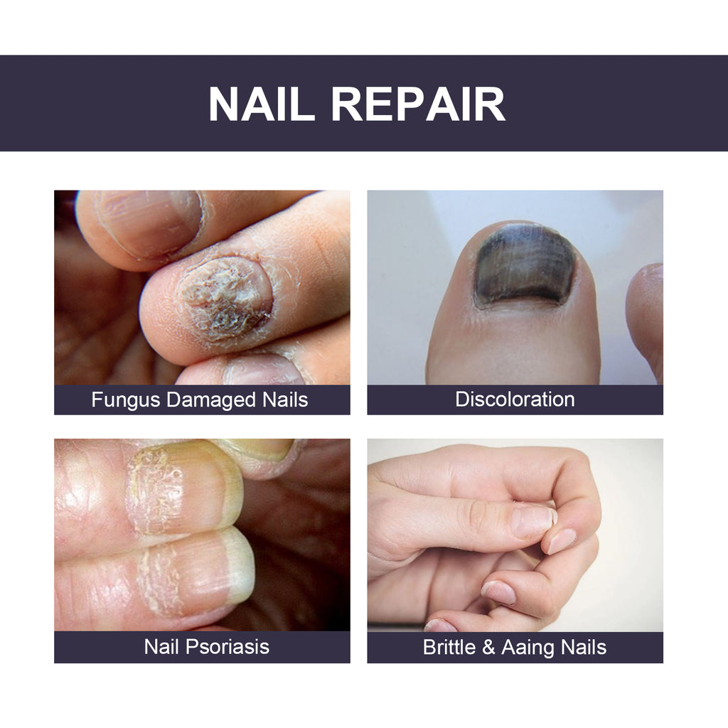 Nail Repair Essence, Soft Nail Thickening Nails Smooth Ingrown Toenails Grey Nails Repair Essence