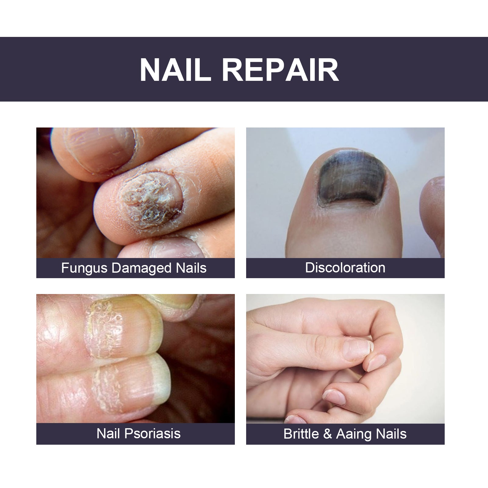 Nail Repair Essence, Soft Nail Thickening Nails Smooth Ingrown Toenails Grey Nails Repair Essence