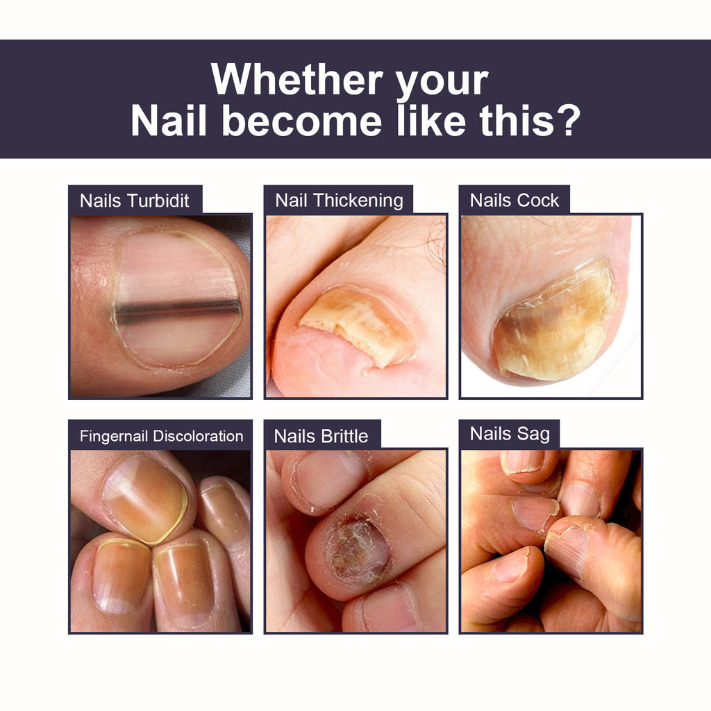 Nail Repair Essence, Soft Nail Thickening Nails Smooth Ingrown Toenails Grey Nails Repair Essence
