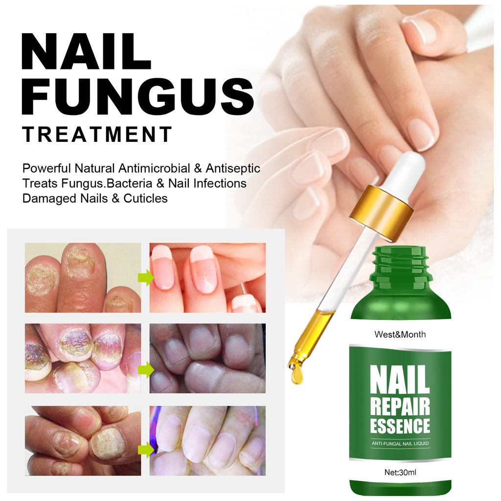 Nail Repair Essence, Hand And Foot Thickening Brightening Nails Repair Rotten Nails Bad Nails Remove Ash Nail Infection Clean